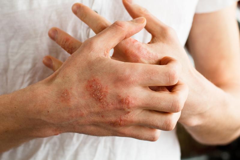 dermatitis atopica manos